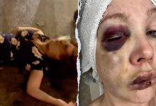 Cincinnati beatdown victim reveals ‘very bad brain trauma’ in first remarks since viral assault